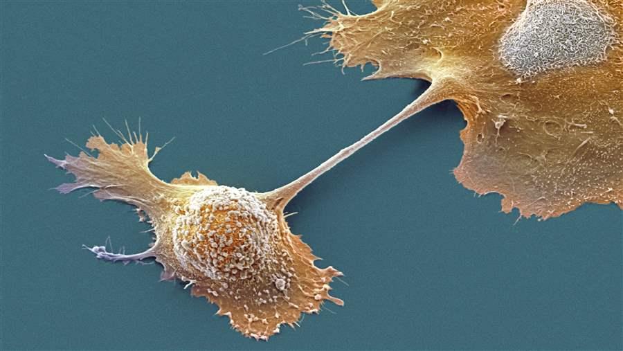 Pancreatic cancer cells.