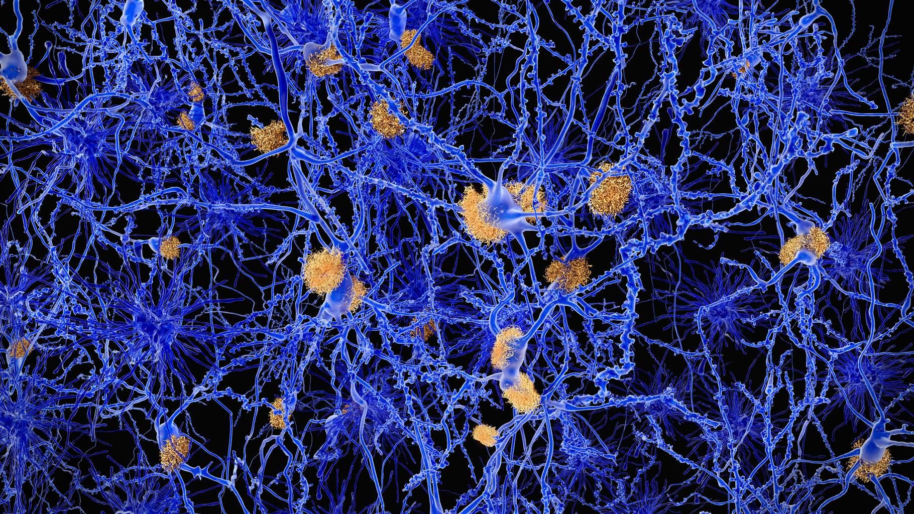 Computer illustration of amyloid plaques amongst neurons