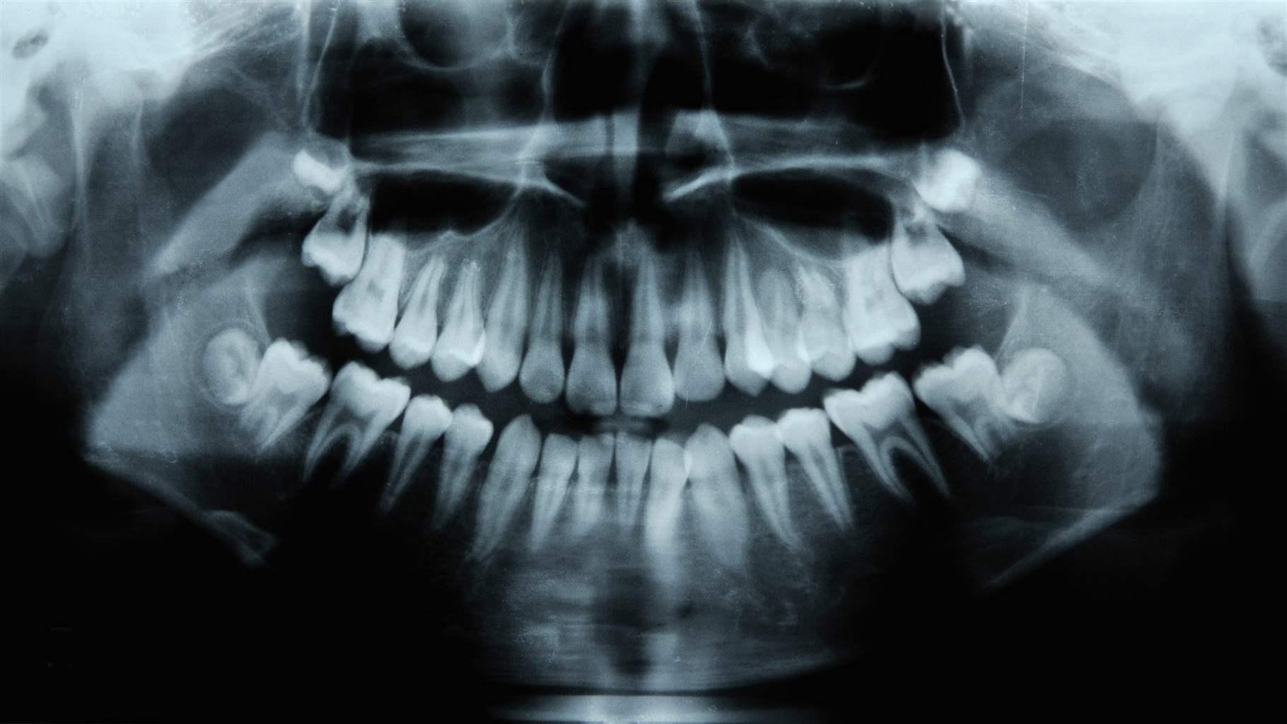 Child's dental X-rays