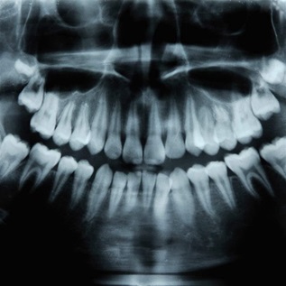 Child's dental X-rays