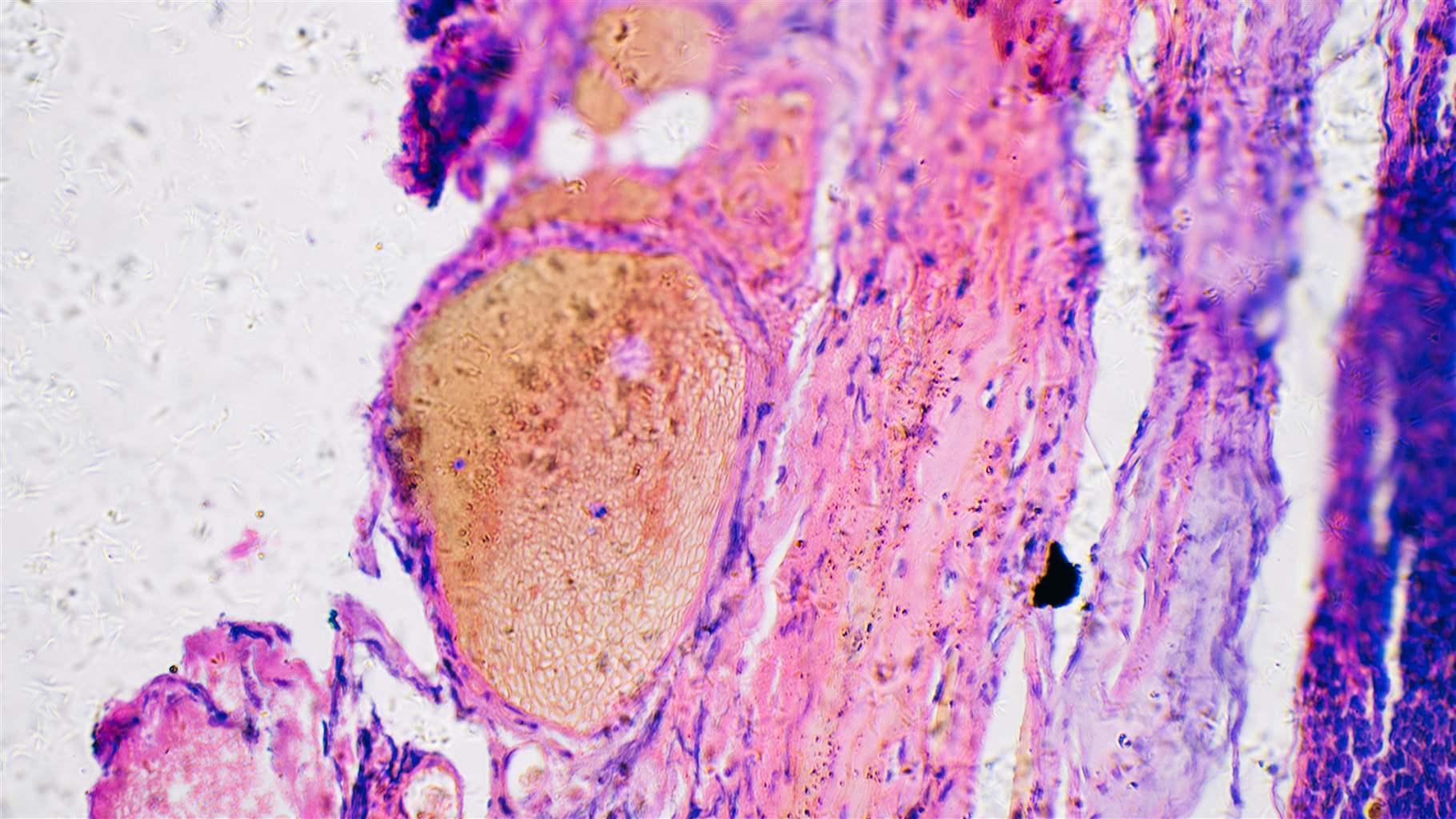 Melanoma cancer cells 