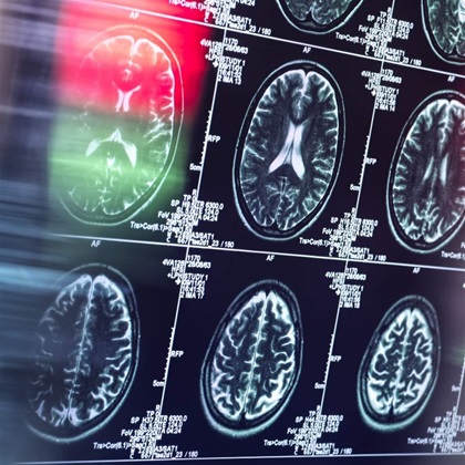 Human brain scan in neurology clinic