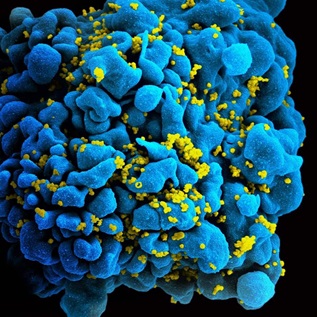 A bright blue T-cell infected by HIV is engulfed by hundreds of yellow virions.